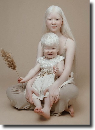 albino people